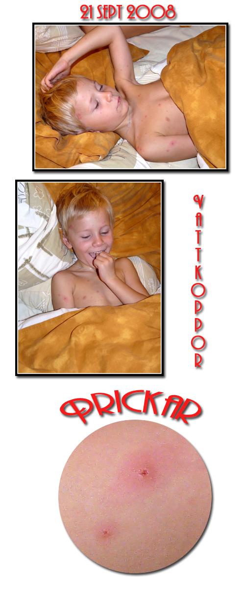 vattkoppor